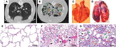 Complement as a vital nexus of the pathobiological connectome for acute respiratory distress syndrome: An emerging therapeutic target